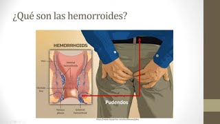 ¿Qué son las hemorroides [upl. by Sicular]