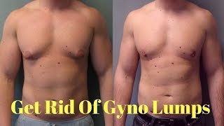 how to get rid of gynecomastia lumps  gynecomastia cure [upl. by Remark]