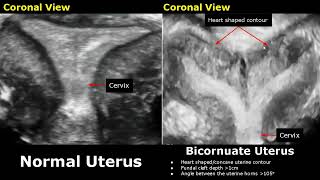 Congenital Uterine Abnormalities Ultrasound Normal Vs Abnormal Image Appearances  Uterus USG Scan [upl. by Bunder]