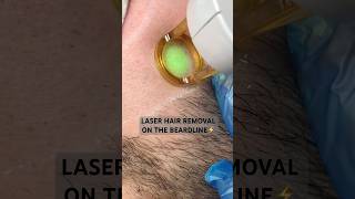 Laser hair removal on the beardline ⚡️ [upl. by Enetsuj]