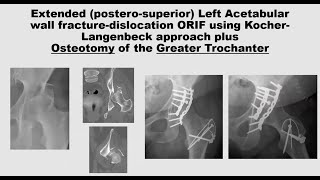 Tension band and cerclage wiring techniques for fracture fixation [upl. by Avle681]