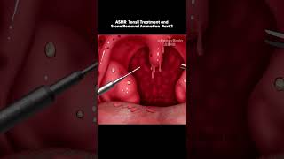 ASMR Tonsil Treatment and Stone Removal Animation Bad Breath Part 2 [upl. by Balbinder]