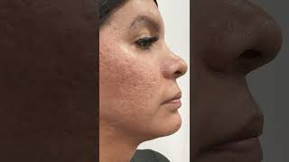 Testimonio Peeling de Fenol [upl. by Goldenberg186]