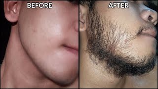 Minoxidil Beard Journey 3 MONTH TRANSFORMATION  BEFORE and AFTER [upl. by Jb]