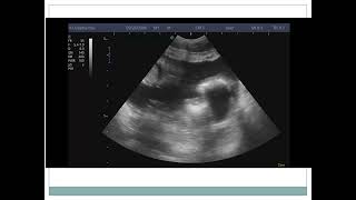 CASE 6 purulent peritonitis due to perforated appendicitis [upl. by Trixie854]