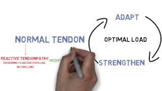 The Tendinopathy Continuum [upl. by Budworth]