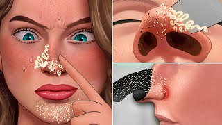 ASMR Satisfying Full Blackhead and Secretions Removal Treatment  Skincare animation [upl. by Ailemak]