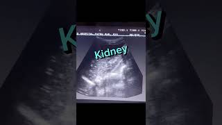 Echogenic Kidney shorts youtube viral [upl. by Aneehsram]