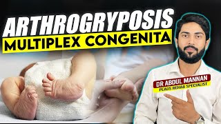 Understanding Arthrogryposis Multiplex Congenita Causes Symptoms and Treatment Options [upl. by Tselec]