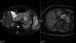 Abdominal Case Conference  772020 [upl. by Nynnahs]