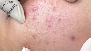 ACNE TREATMENT VU QUYNH MI Acne On Boys Chin 2024 [upl. by Nuhs]