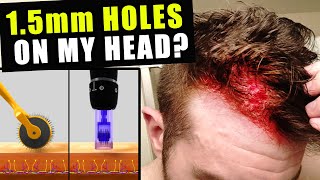 I Cut Thousands Of 15 Millimetre Holes In My Head Every Week To Prevent Hair Loss [upl. by Meggy]