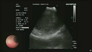 Lymphnode erosion into bronchus  Endobronchial Ultrasound EBUS [upl. by Ained]