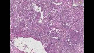 Histopathology Lymph nodeMetastatic breast carcinoma [upl. by Zephaniah]