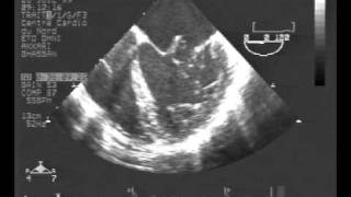 infective endocarditisTEE chordal rupture of both leaflets of the mitral valve [upl. by Cahra23]