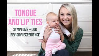 TONGUE AND LIP TIE SYMPTOMS IN BABIES  TONGUE AND LIP TIE LASER REVISION EXPERIENCE [upl. by Alecia525]