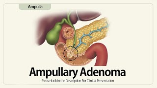 Ampullary Adenoma or T1 Ampullary Adenocarcinoma [upl. by Ric]