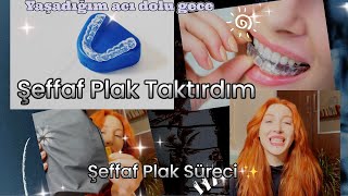 Şeffaf Plak Taktırdım  invisalign Tedavisi  Şeffaf Plak Sürecinde Yaşadıklarım [upl. by Angelico]