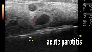 Acute parotitis ultrasound and color Doppler imaging video [upl. by Neeruan240]