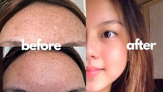 How I FINALLY Cleared My Skin ft Tiny Bumps  Comedonal Acne  Philippines [upl. by Eislehc543]