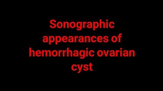 Sonographic appearances of hemorrhagic ovarian cyst [upl. by Guod347]