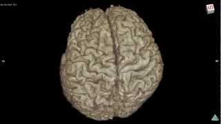 Variation of brain cortex 3D MRI sample Bgo [upl. by Imotih280]