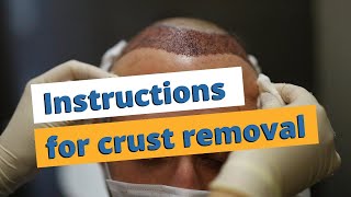 Removing crusts after hair transplant ►Instructions for crust removal◄ [upl. by Kurtis436]