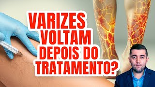 Varizes Diga Adeus com o Tratamento Certo Laser Cirurgia Aplicação ou Espuma Densa Qual melhor [upl. by Korry]