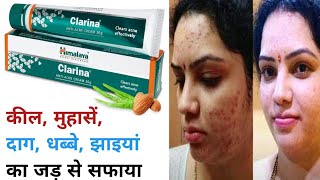 Himalaya Clarina Antiacne Cream Review  Kaise use kare  Results  Acne Removal Cream [upl. by Eilrahc52]