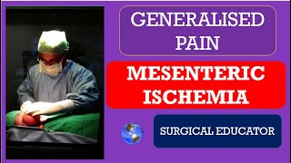 MESENTERIC ISCHEMIA How To DIAGNOSE amp TREAT GENERALISED ABDOMINAL PAIN [upl. by Care245]