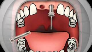 Impression Post in oral Implantology [upl. by Ahsote]