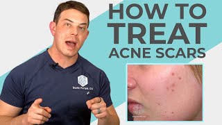 What do Experts Recommend for Acne Scars  208SkinDoc [upl. by Donnelly985]