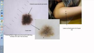 Dermoscopy Made Simple  Reed nevus [upl. by Ellan794]