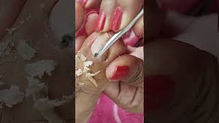 cleaning toenail full of ingrown videos pedicure subscribe [upl. by Beckie305]