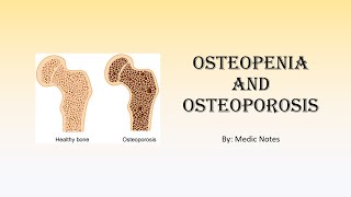 Osteopenia and osteoporosis  definition types investigation DEXA scan treatment complications [upl. by Stevena]