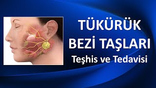 TÜKÜRÜK BEZİ TAŞLARI Teşhis ve Tedavisi [upl. by Karisa]