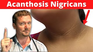 What is Acanthosis Nigricans Its NOT Dirty Neck Its a Sign Dark Underarms [upl. by Mitran718]