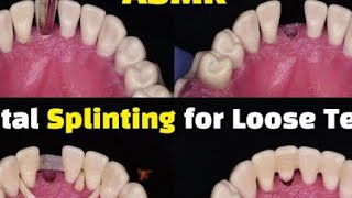 Dental Splinting for loose teeth using a ribbond after tooth extraction [upl. by Akiaki684]