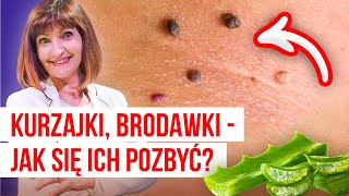 🚩 Kurzajki Brodawki  jak się ich pozbyć 🚩 13 domowych sposobów by znikły bez śladu 🚩 [upl. by Katie]