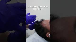 Why should you get Hair Exosomes therapy [upl. by Adnesor]