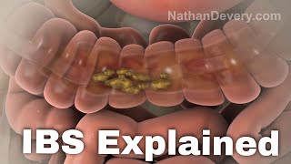 What is irritable bowel syndrome IBS explained [upl. by Esiom]