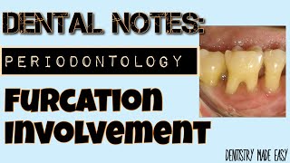 FURCATION INVOLVEMENT II DENTAL NOTES II STUDY WITH ME II PERIODONTOLOGY [upl. by Alleb]