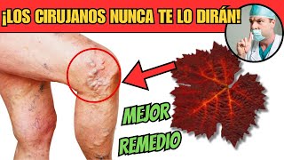 Una SOLUCIÓN SENCILLA para las VÁRICES 🟢 Mejor REMEDIO Para las VÁRICES [upl. by Jala]