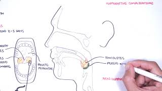 Strep throat streptococcal pharyngitis pathophysciology signs and symptoms diagnosis treatment [upl. by Ojeillib]