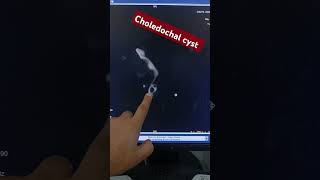 mrcp choledochal cyst Mrcp case [upl. by Aneekan]