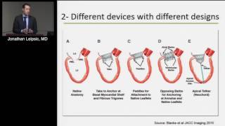 CT for Transcatheter Mitral and Tricuspid Interventions Jonathan Leipsic MD March 16 2017 [upl. by Apicella]