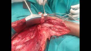 Brachial Plexus Surgery by DrManish Nanda Intercostal nerve transfer to Musculocutaneous nerve [upl. by Anitnerolf]