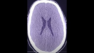 Acute Brain edema post cardiac arrest [upl. by Itsirk]