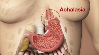 Symptoms of Achalasia amp Clinical Presentation [upl. by Echikson]