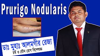 Prurigo Nodularis চিকিৎসা ও সঠিক ব্যবস্থাপনা  ডা আলমগীর রেজা  প্রুরিগো নোডুলারিস চিকিত্সা [upl. by Paige]